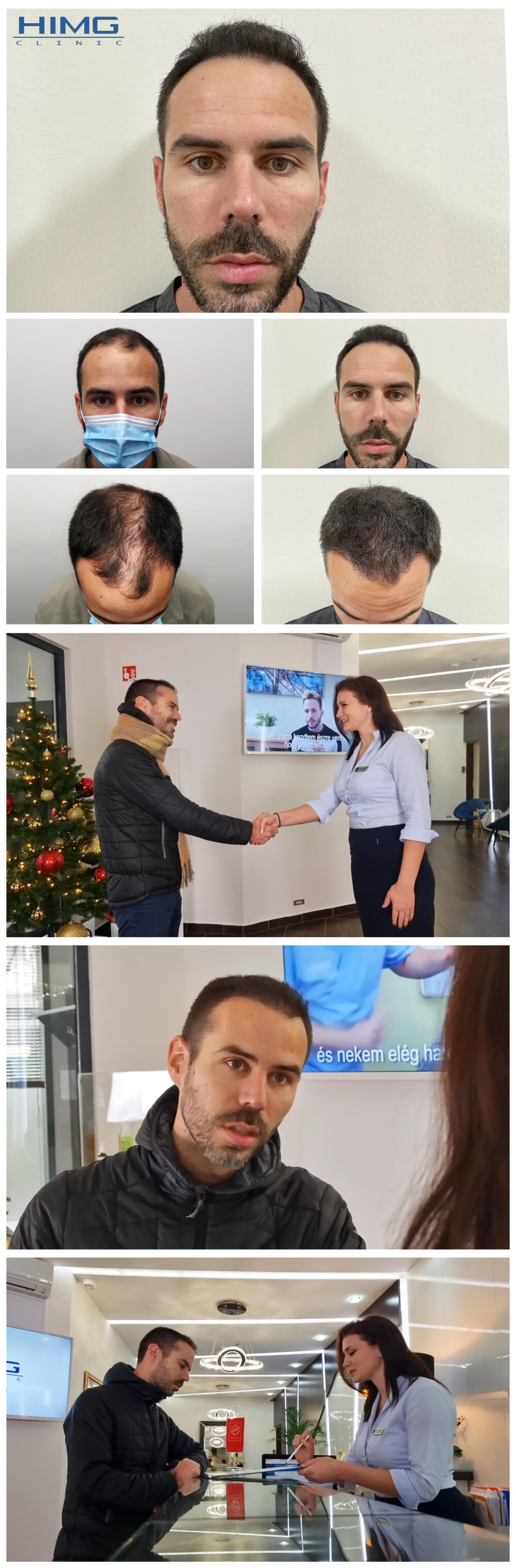 Haartransplantation Vorher - Nachher Bilder - Ergebnisse - Gábor Haartransplantation Vorher - Nachher Bilder - Ergebnisse - Gábor