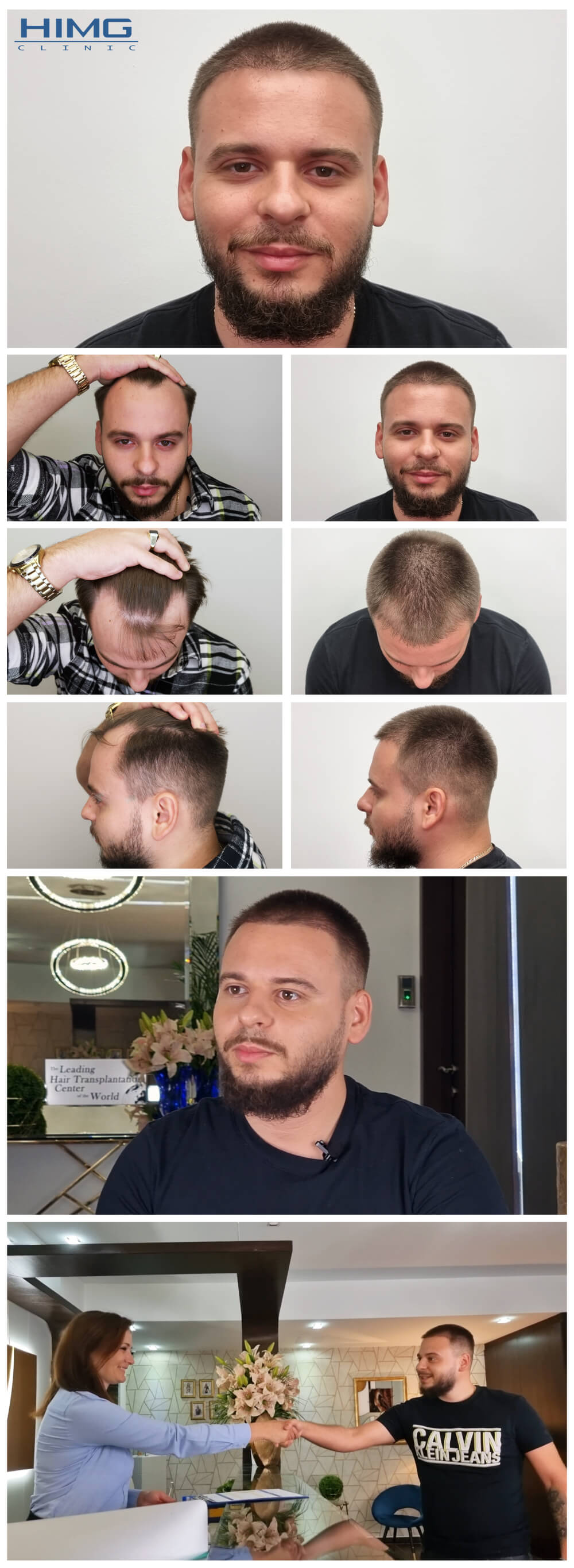 Haartransplantation Vorher - Nachher Bilder - Ergebnisse - Georgios Haartransplantation Vorher - Nachher Bilder - Ergebnisse - Georgios