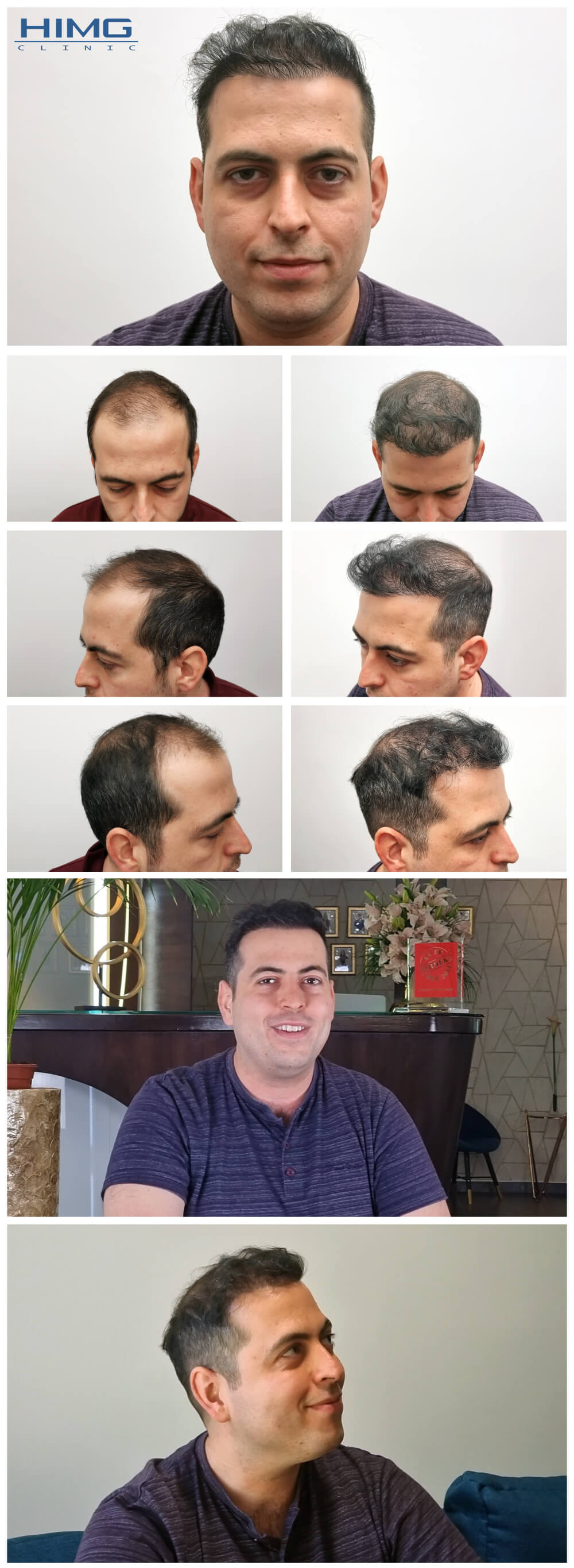 Haartransplantation Vorher - Nachher Bilder - Ergebnisse - János Haartransplantation Vorher - Nachher Bilder - Ergebnisse - János