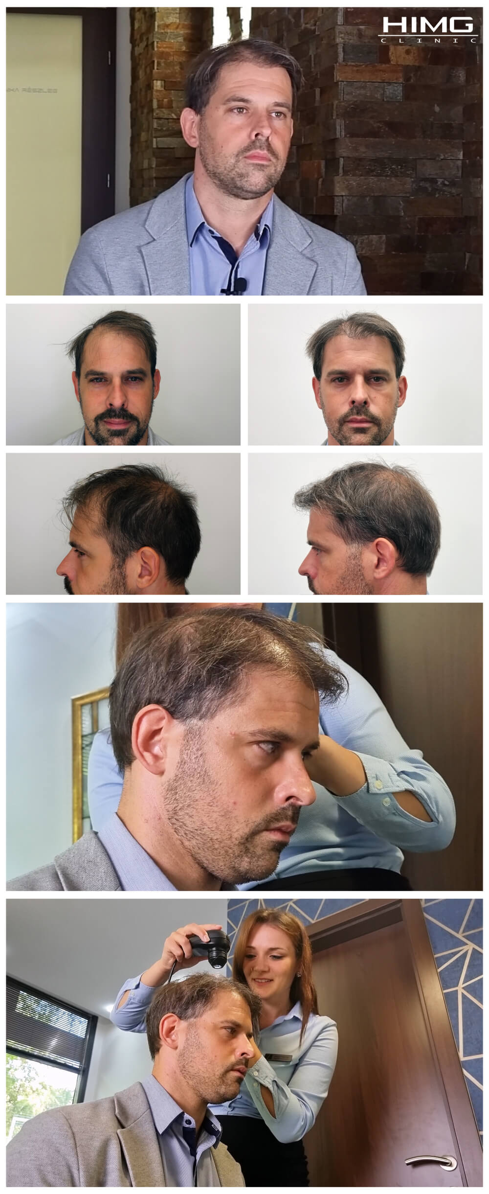 Haartransplantation Vorher - Nachher Bilder - Ergebnisse - Tibor Haartransplantation Vorher - Nachher Bilder - Ergebnisse - Tibor