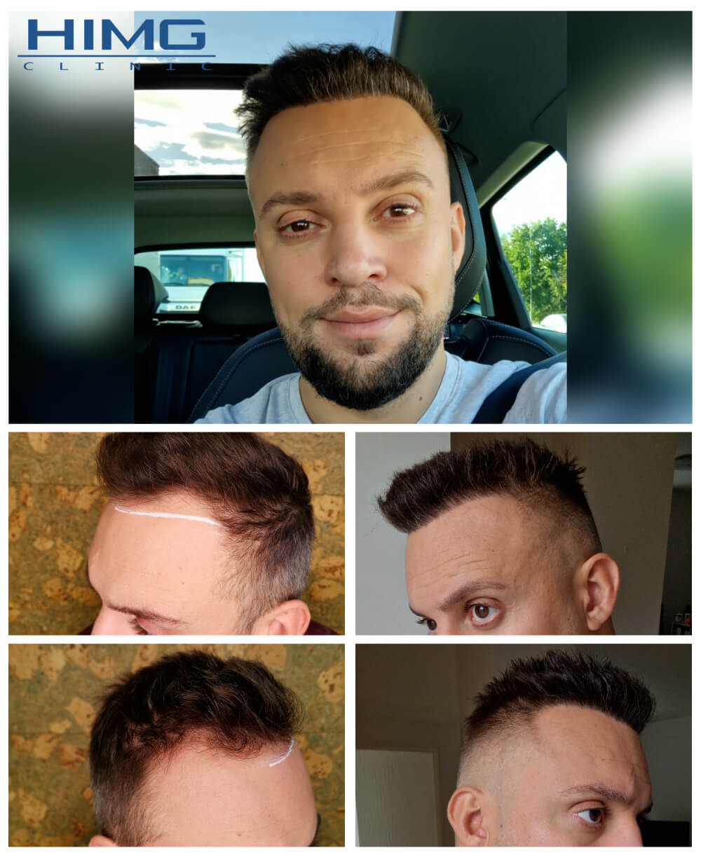 Haartransplantation Vorher - Nachher Bilder - Ergebnisse - Jan Haartransplantation Vorher - Nachher Bilder - Ergebnisse - Jan.