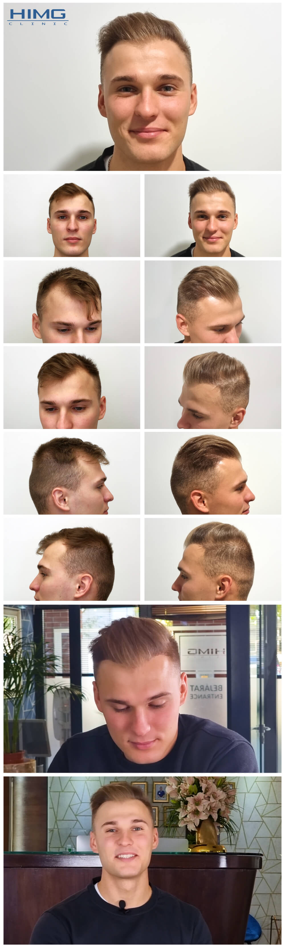 Haartransplantation Vorher - Nachher Bilder - Ergebnisse - Norbert Haartransplantation Vorher - Nachher Bilder - Ergebnisse - Norbert