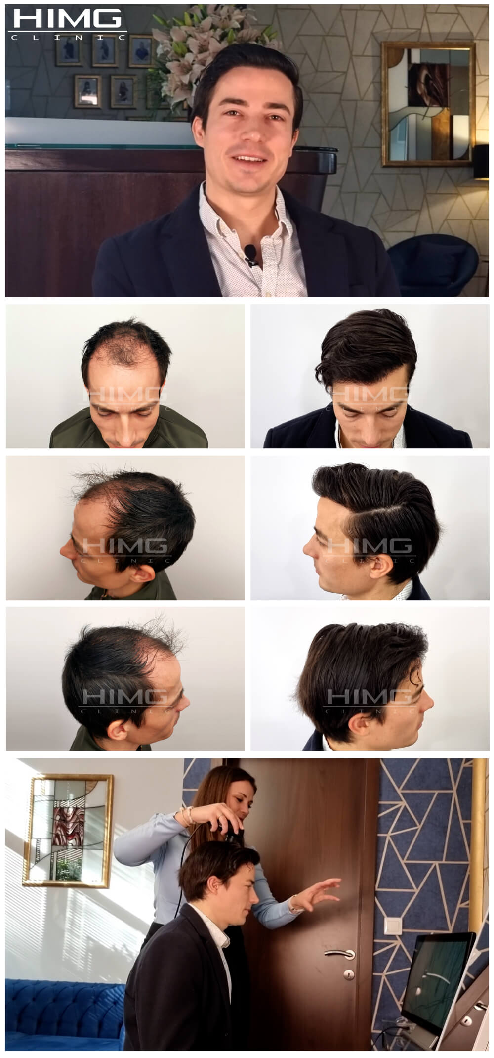 Haartransplantation Vorher - Nachher Bilder - Ergebnisse - Gáspár Gergő Haartransplantation Vorher - Nachher Bilder - Ergebnisse - Gergő