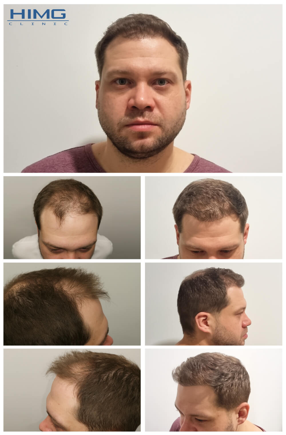 Haartransplantation Vorher - Nachher Bilder - Ergebnisse - Máté Haartransplantation Vorher - Nachher Bilder - Ergebnisse - Máté