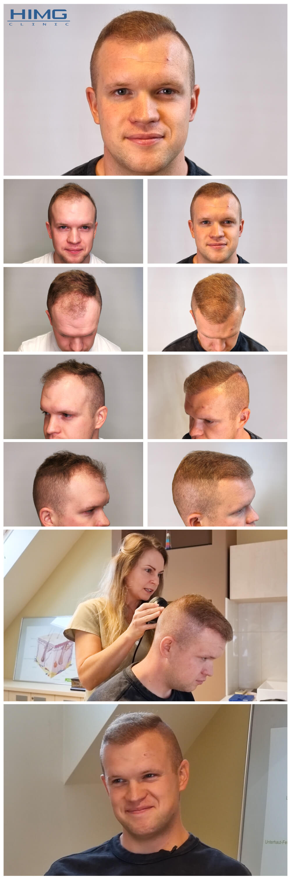 Haartransplantation Vorher - Nachher Bilder - Ergebnisse - Patrik Haartransplantation Vorher - Nachher Bilder - Ergebnisse - Patrik