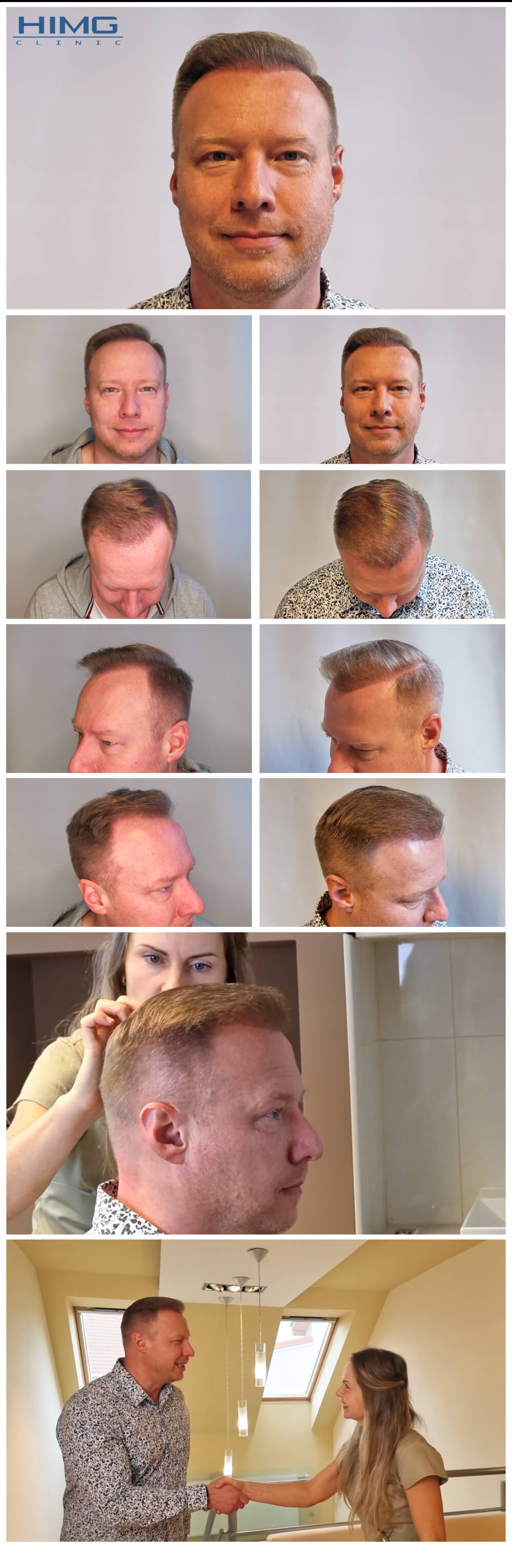 Haartransplantation Vorher - Nachher Bilder - Ergebnisse - Pavel Haartransplantation Vorher - Nachher Bilder - Ergebnisse - Pavel