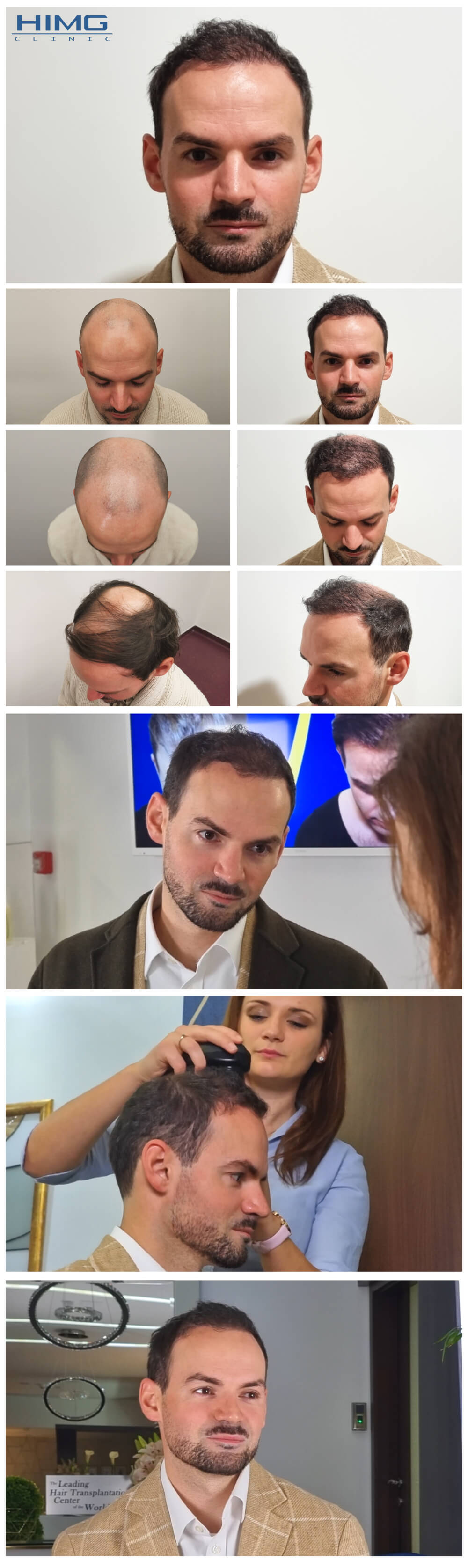 Haartransplantation Vorher - Nachher Bilder - Ergebnisse - Tamás Haartransplantation Vorher - Nachher Bilder - Ergebnisse - Tamás