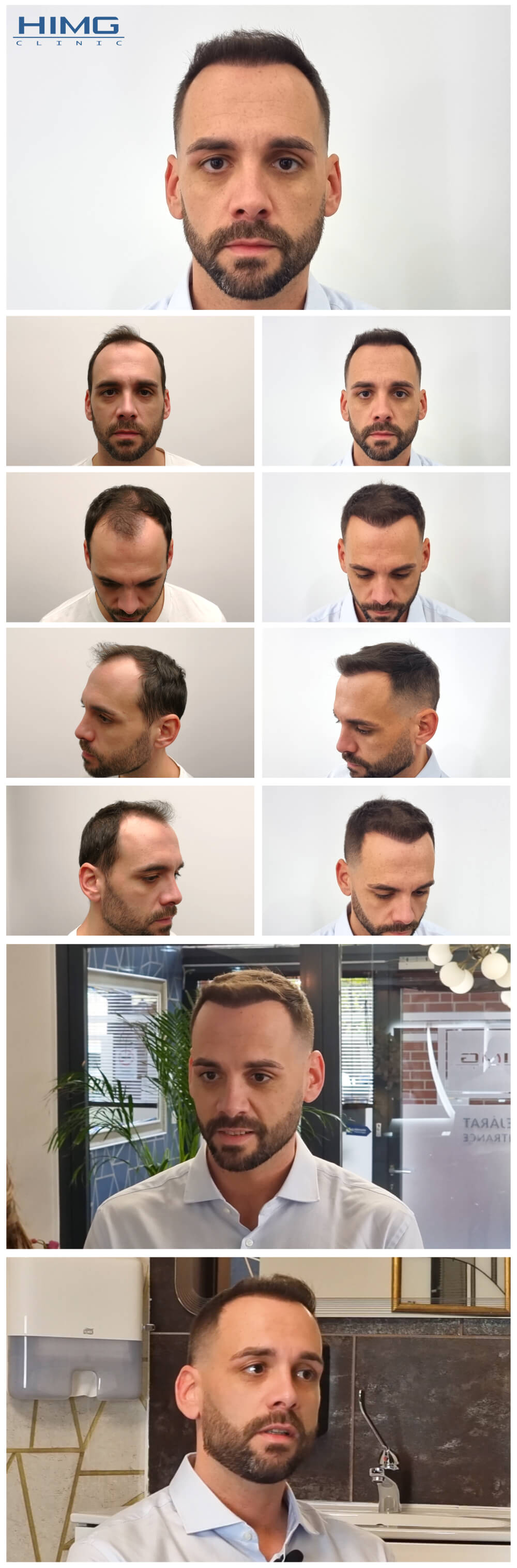 Haartransplantation Vorher - Nachher Bilder - Ergebnisse - Balázs Haartransplantation Vorher - Nachher Bilder - Ergebnisse - Balázs