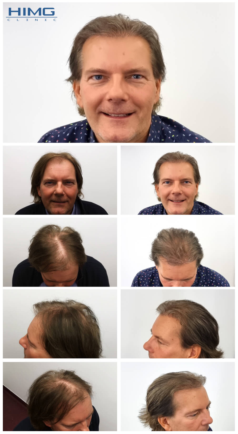 Haartransplantation Vorher - Nachher Bilder - Ergebnisse - Bolivár Haartransplantation Vorher - Nachher Bilder - Ergebnisse - Bolivár