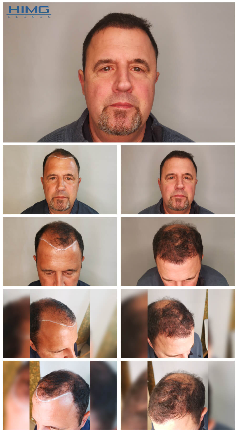 Hajbeültetés előtte-utána fotók - eredmények - Günther Hajbeültetés előtte-utána fotók - eredmények - Günther