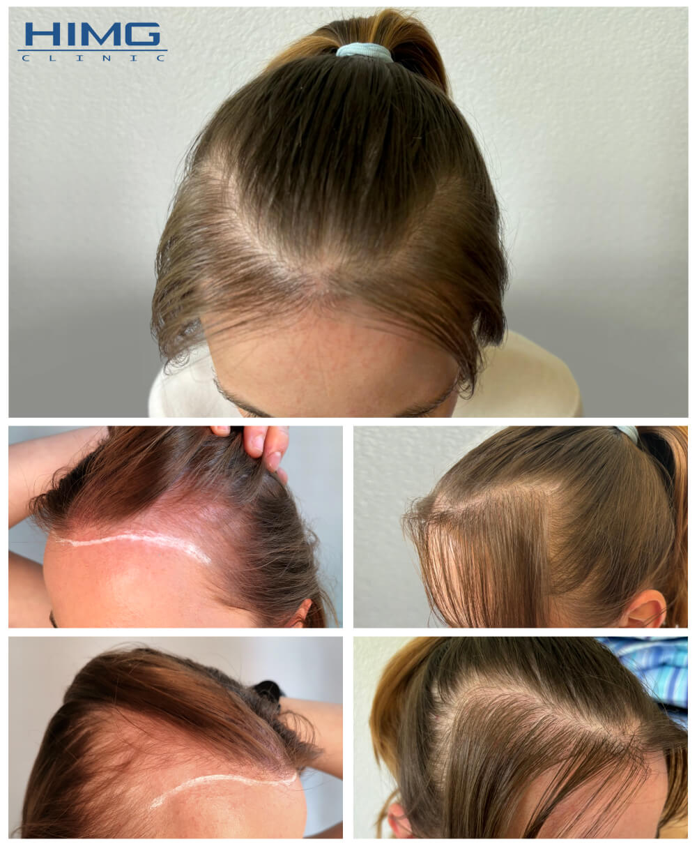 Haartransplantation Vorher - Nachher Bilder - Ergebnisse - Ivana Haartransplantation Vorher - Nachher Bilder - Ergebnisse - Ivana