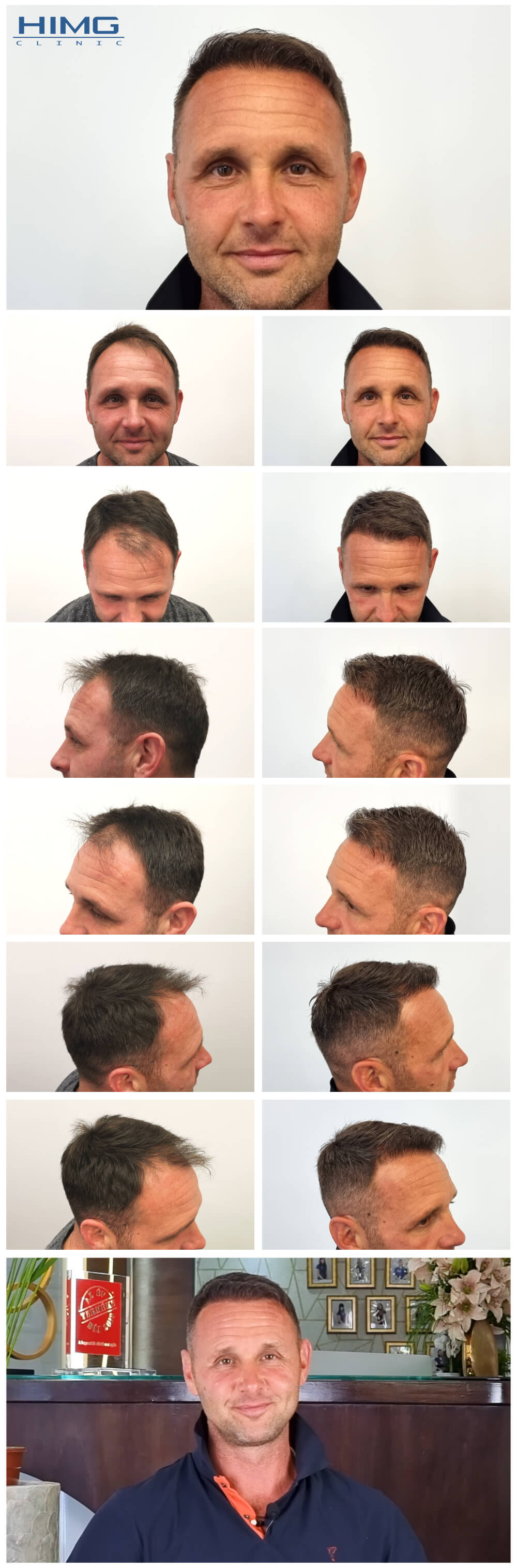 Haartransplantation Vorher - Nachher Bilder - Ergebnisse - József Haartransplantation Vorher - Nachher Bilder - Ergebnisse - József