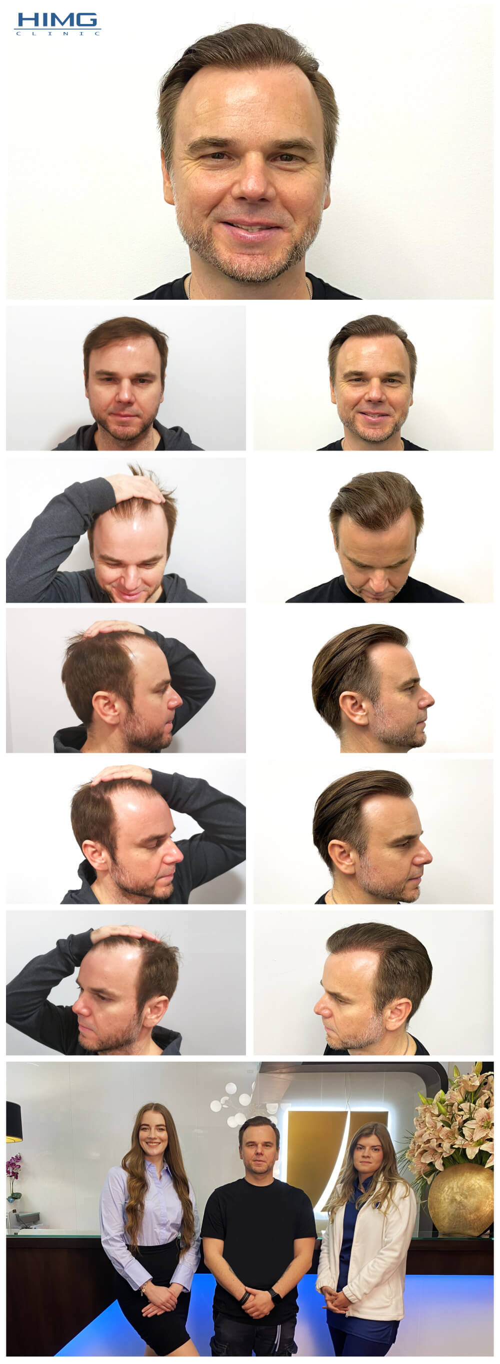 Hajbeültetés előtte-utána fotók - eredmények - Juhász Gergely