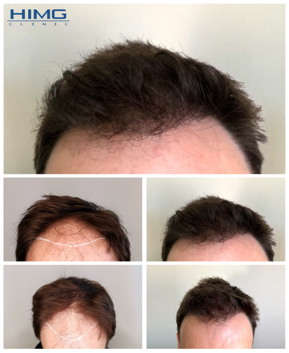 Haartransplantation Vorher - Nachher Bilder - Ergebnisse - Juraj Haartransplantation Vorher - Nachher Bilder - Ergebnisse - Juraj