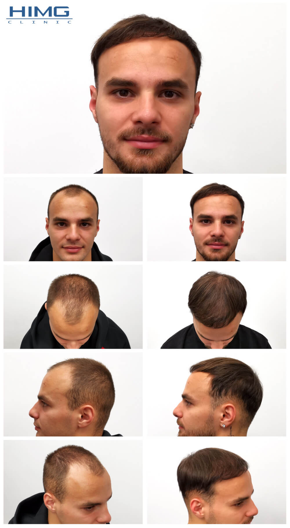 Haartransplantation Vorher - Nachher Bilder - Ergebnisse - Kevin Haartransplantation Vorher - Nachher Bilder - Ergebnisse - Kevin