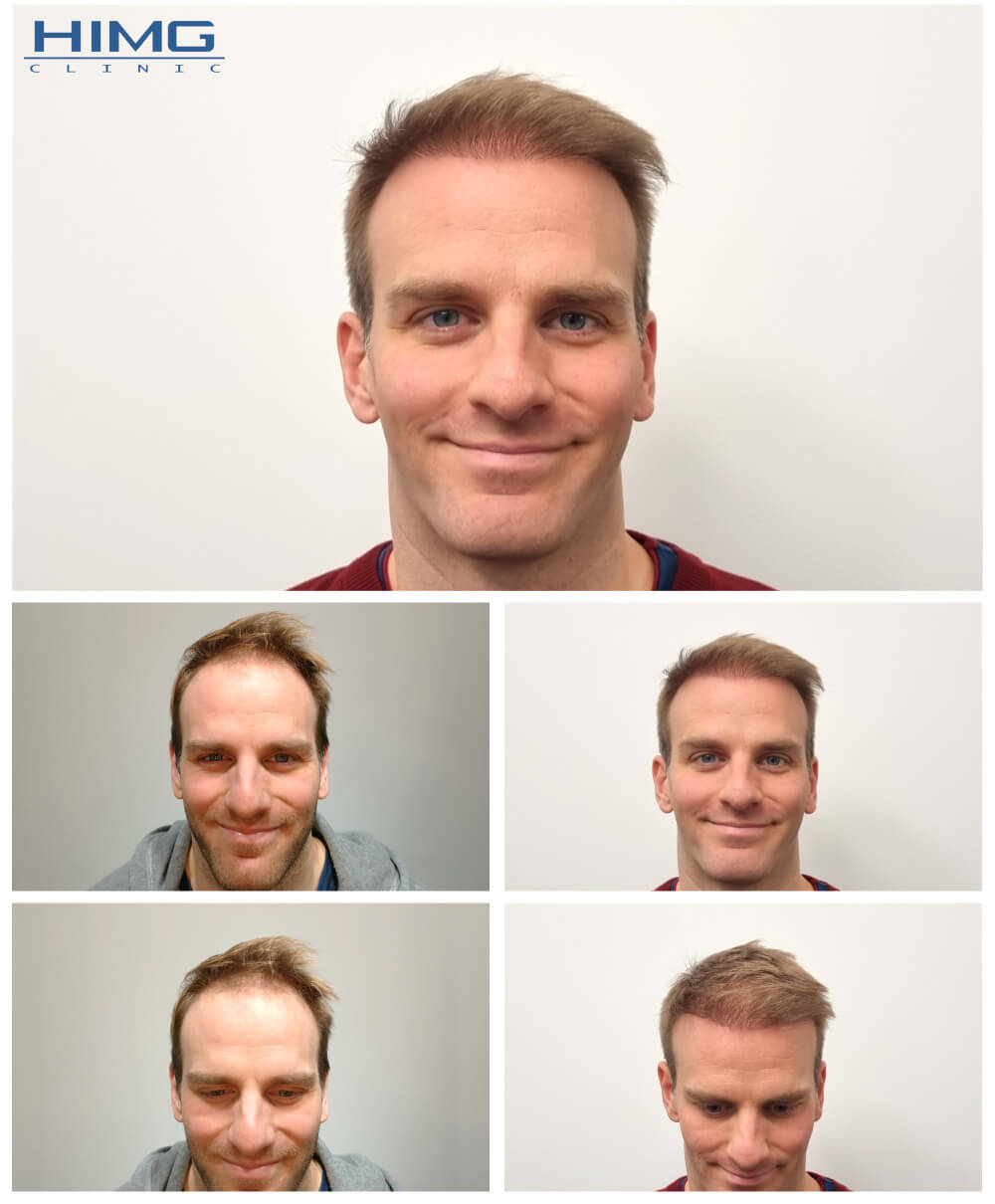 Hajbeültetés előtte-utána fotók - eredmények