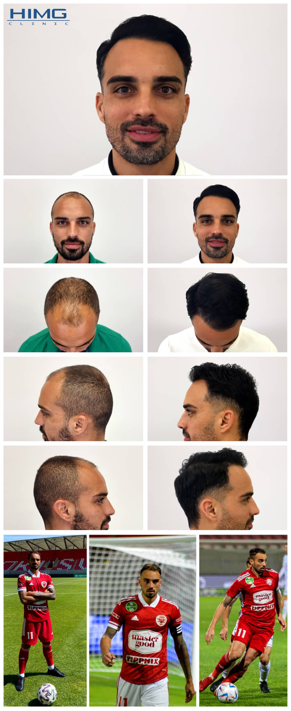 Haartransplantation Vorher - Nachher Bilder - Ergebnisse - M.D. Bertucci Lucas Haartransplantation Vorher - Nachher Bilder - Ergebnisse - M.D. Bertucci