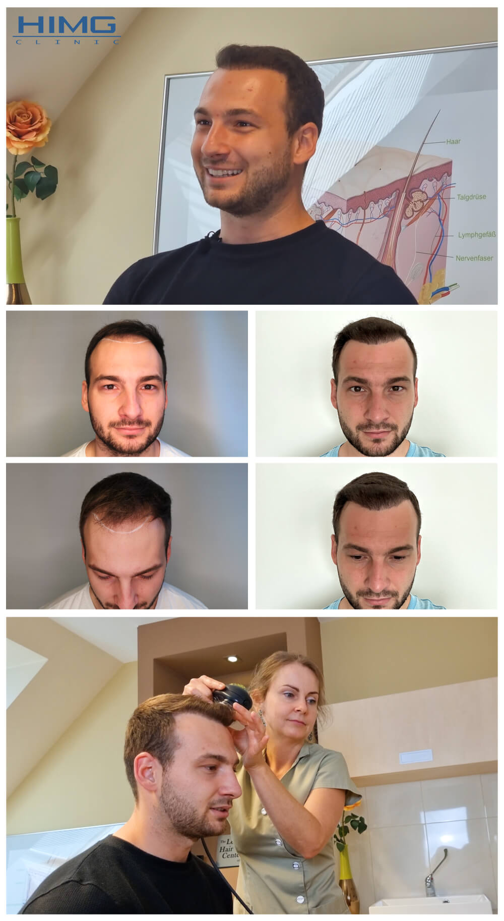 Haartransplantation Vorher - Nachher Bilder - Ergebnisse - Matúš Haartransplantation Vorher - Nachher Bilder - Ergebnisse - Matúš