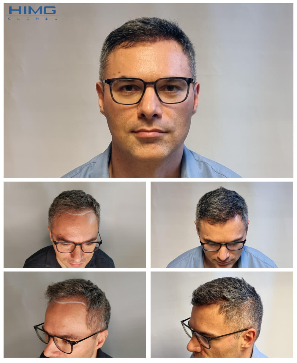 Hajbeültetés előtte-utána fotók - eredmények - Pavel Hajbeültetés előtte-utána fotók - eredmények - Pavel