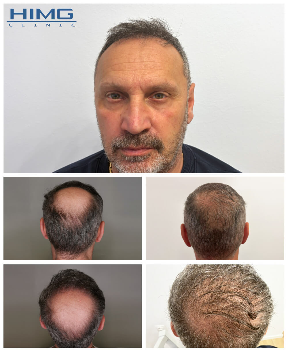 Hajbeültetés előtte-utána fotók - eredmények - Róbert Hajbeültetés előtte-utána fotók - eredmények - Róbert