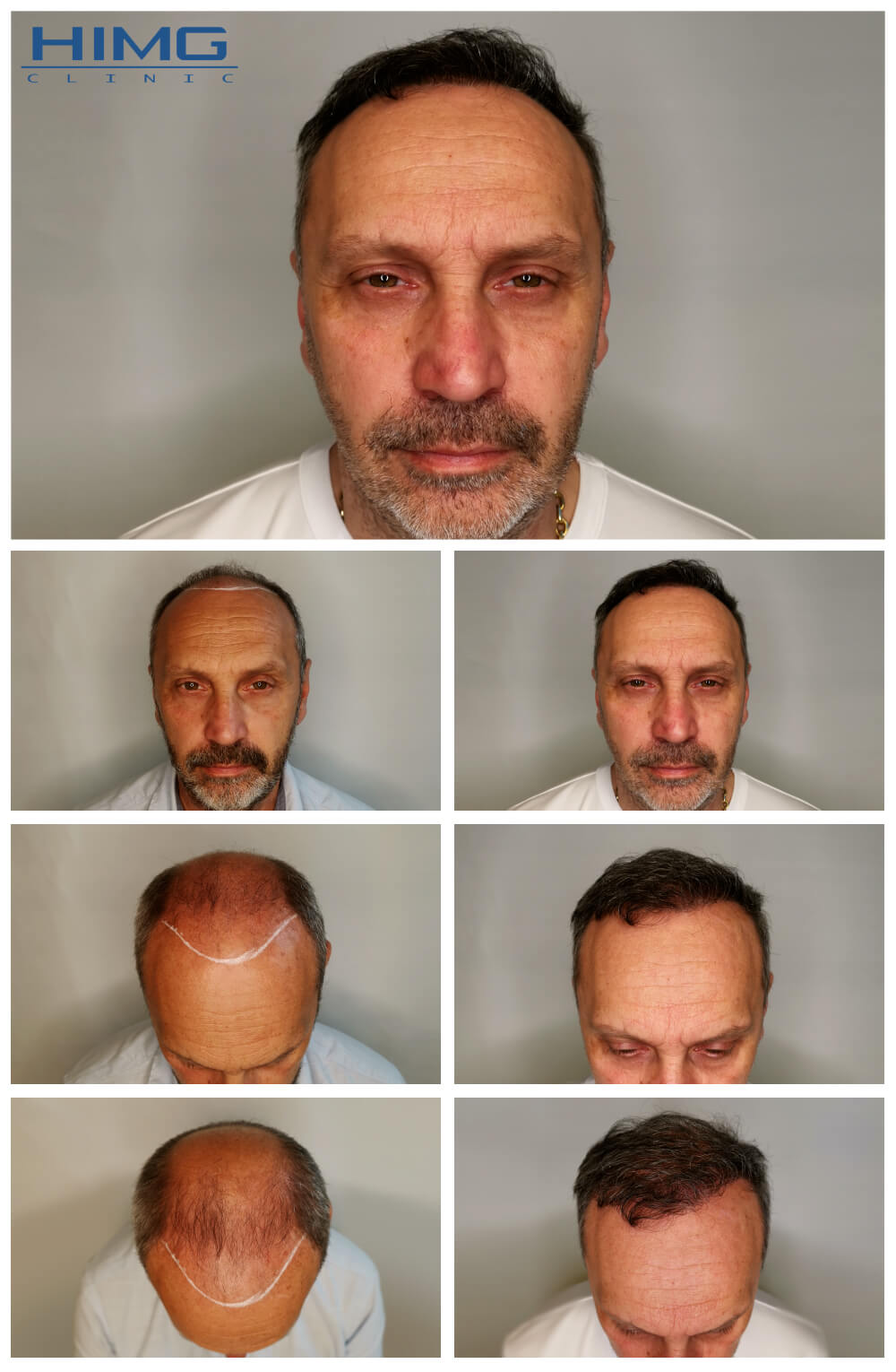 Haartransplantation Vorher - Nachher Bilder - Ergebnisse - Róbert  Haartransplantation Vorher - Nachher Bilder - Ergebnisse - Róbert
