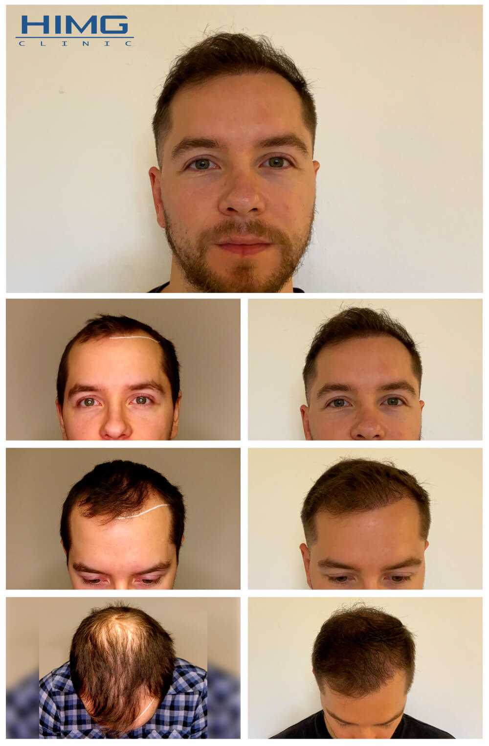 Haartransplantation Vorher - Nachher Bilder - Ergebnisse - Štefan Haartransplantation Vorher - Nachher Bilder - Ergebnisse - Štefan