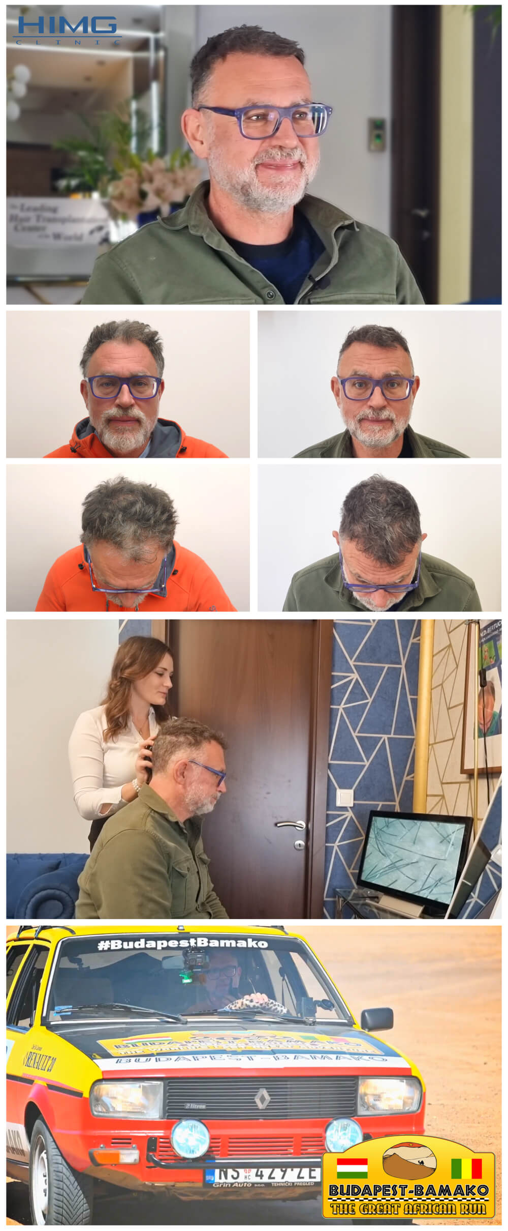 Haartransplantation Vorher - Nachher Bilder - Ergebnisse - Szabó Gál András Haartransplantation Vorher - Nachher Bilder - Ergebnisse - Szabó Gál András