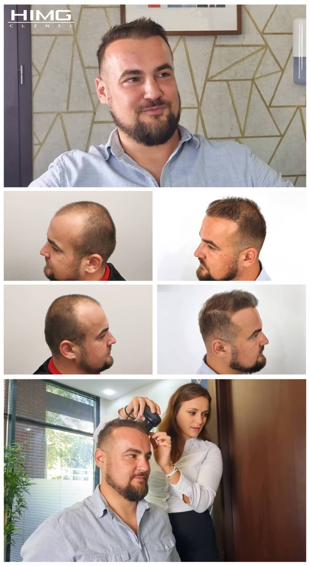 Haartransplantation Vorher - Nachher Bilder - Ergebnisse - Tibor Haartransplantation Vorher - Nachher Bilder - Ergebnisse - Tibor