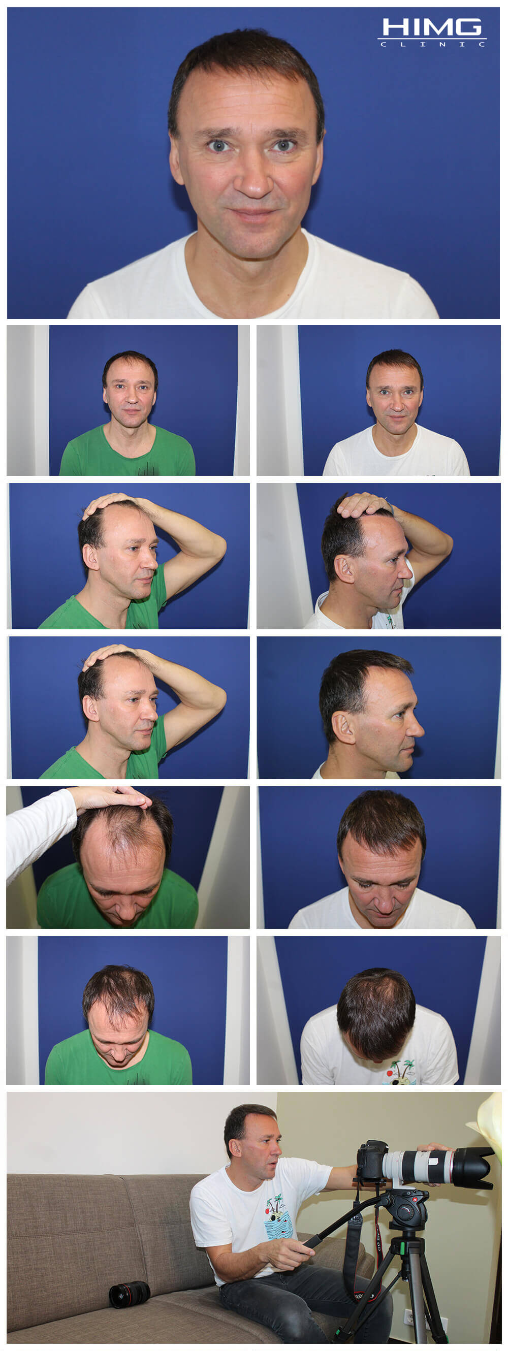 Haartransplantation Vorher - Nachher Bilder - Ergebnisse - K. Tibor Haartransplantation Vorher - Nachher Bilder - Ergebnisse