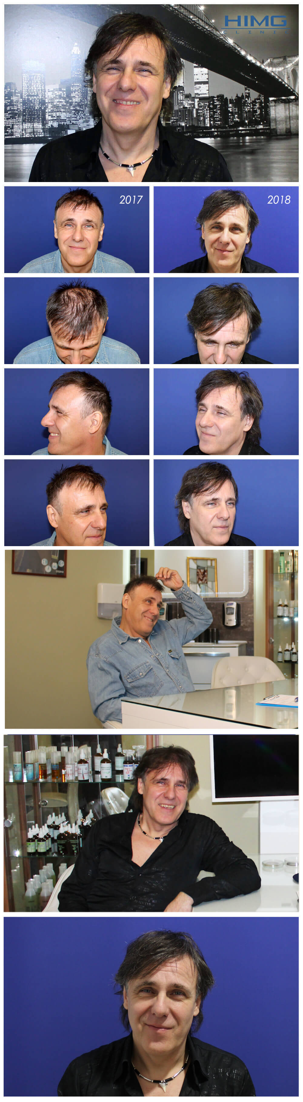 Haartransplantation Vorher - Nachher Bilder - Ergebnisse - Molnár Imre Haartransplantation Vorher - Nachher Bilder - Ergebnisse - Molnár Imre