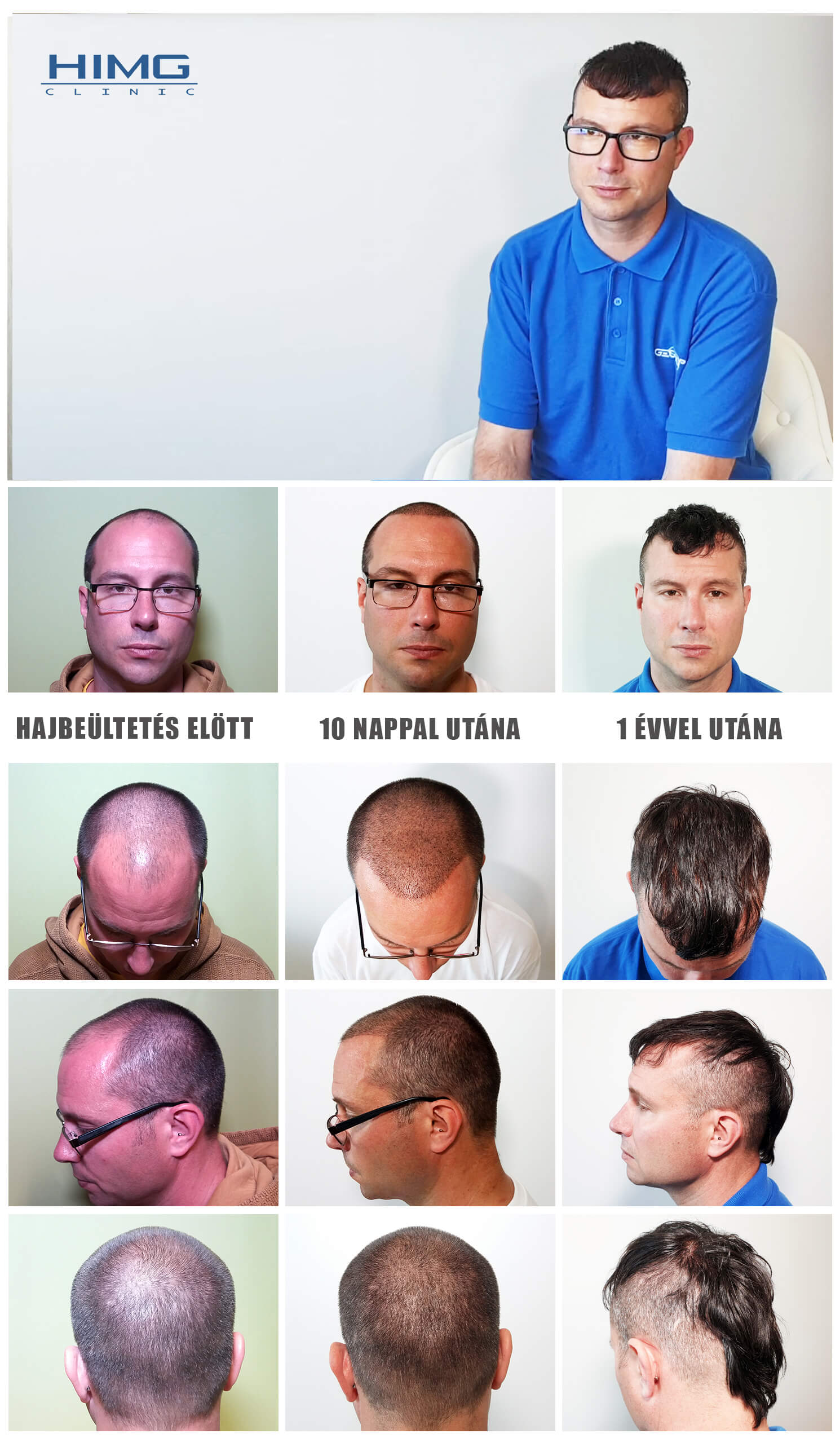 Haartransplantation Vorher - Nachher Bilder - Ergebnisse - Jiri Haartransplantation Vorher - Nachher Bilder - Ergebnisse - Jiri