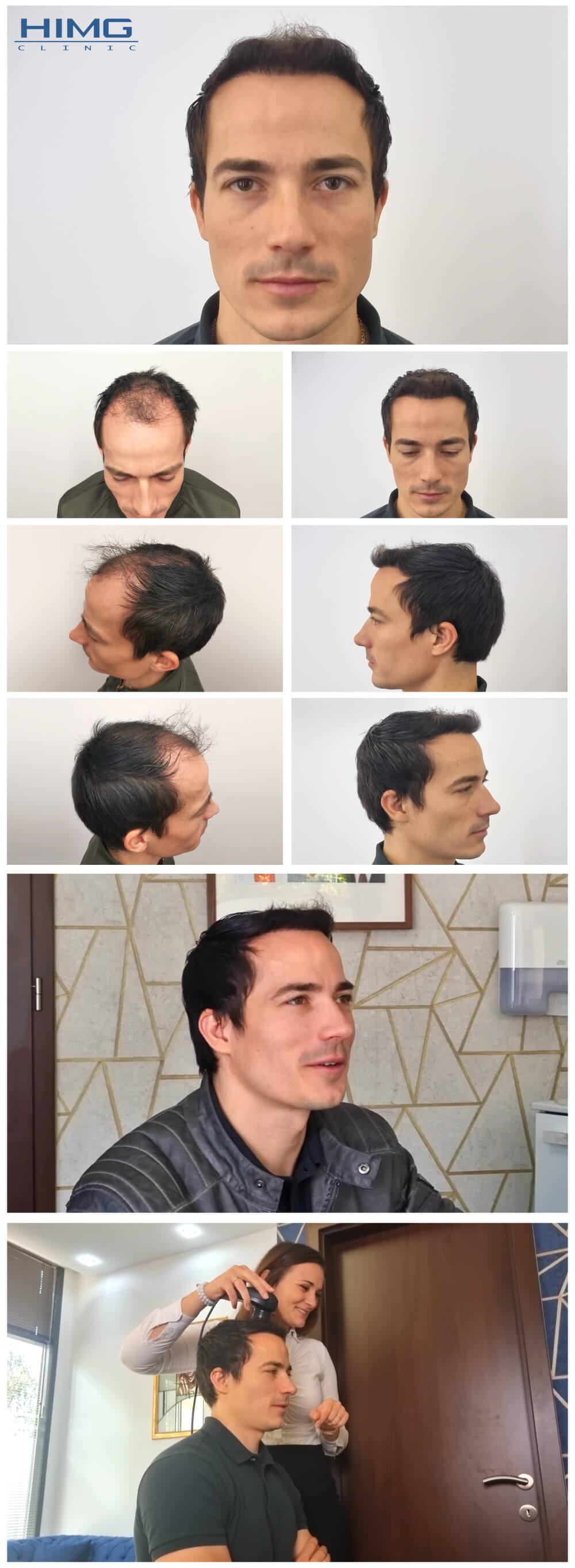 Haartransplantation Vorher - Nachher Bilder - Ergebnisse - Gergely Haartransplantation Vorher - Nachher Bilder - Ergebnisse - Gergely