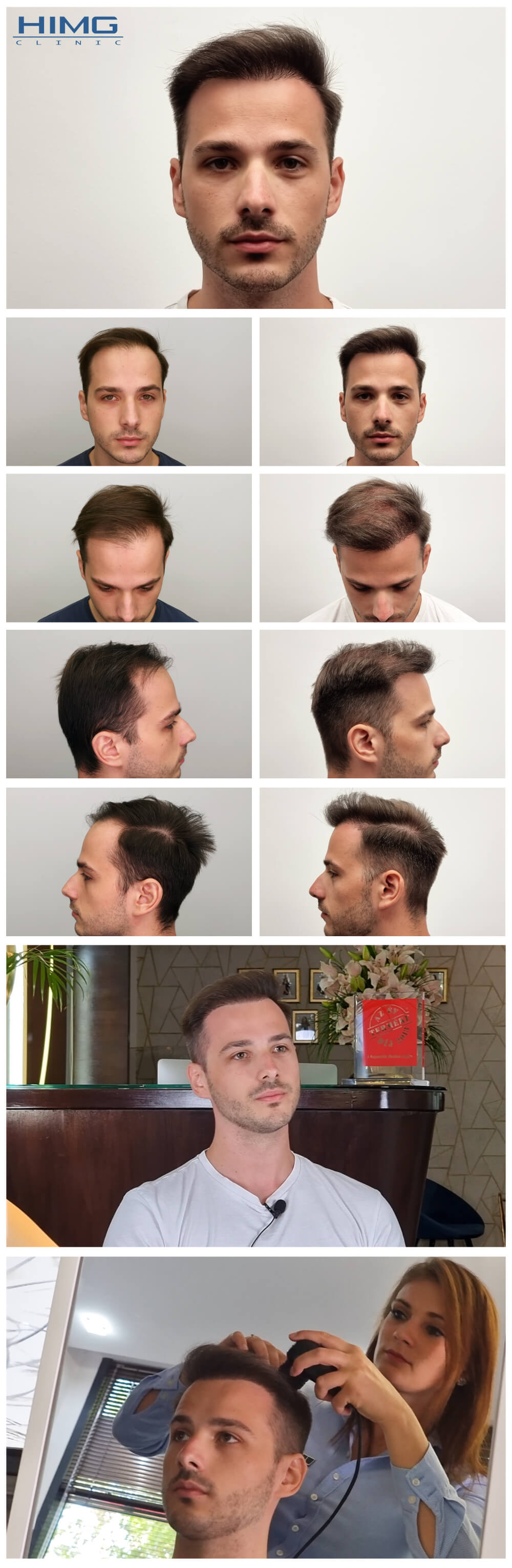 Haartransplantation Vorher - Nachher Bilder - Ergebnisse - Kristóf Haartransplantation Vorher - Nachher Bilder - Ergebnisse - Kristóf