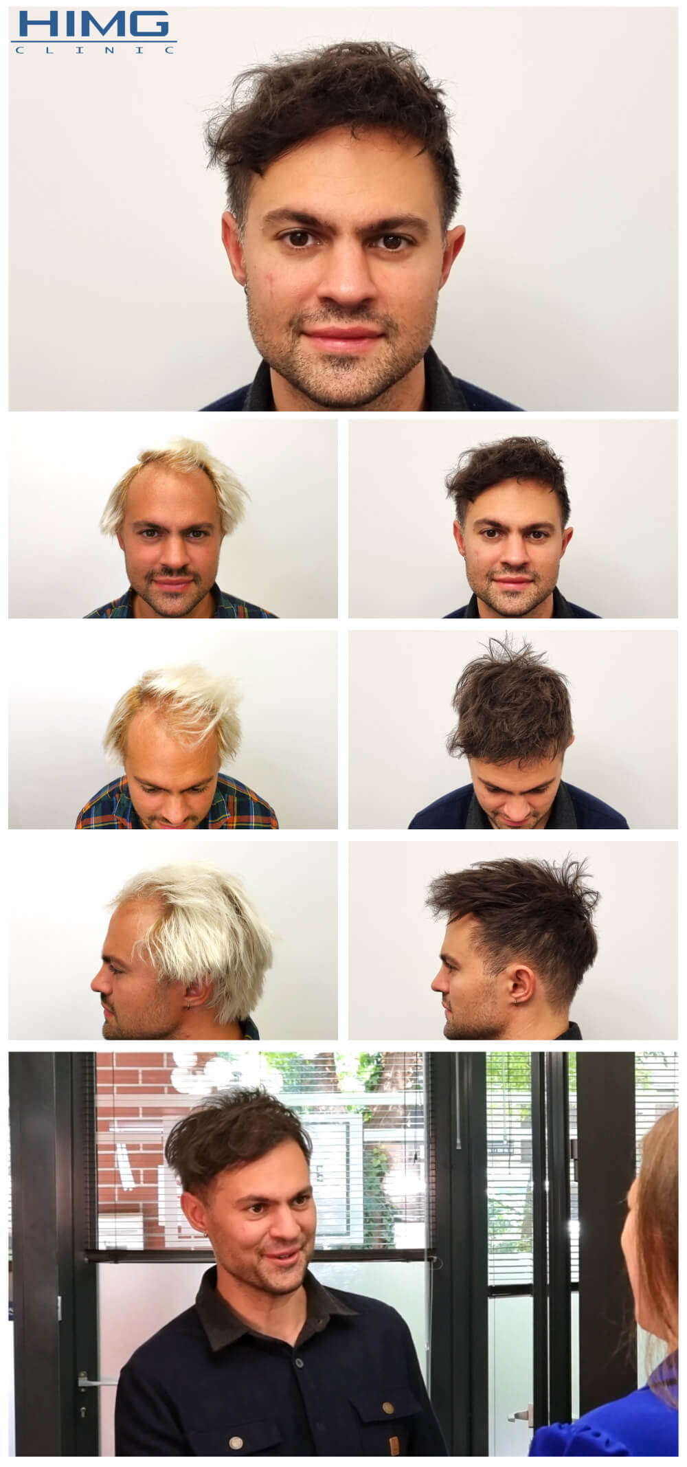 Haartransplantation Vorher - Nachher Bilder - Ergebnisse - Novkov Máté Haartransplantation Vorher - Nachher Bilder - Ergebnisse - Novkov Máté