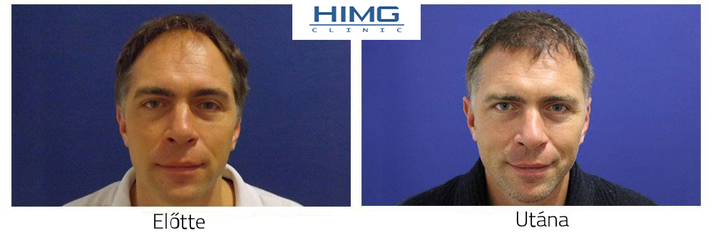 Hajbeültetés férfiaknak