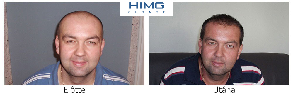 Hajbeültetés előtt után