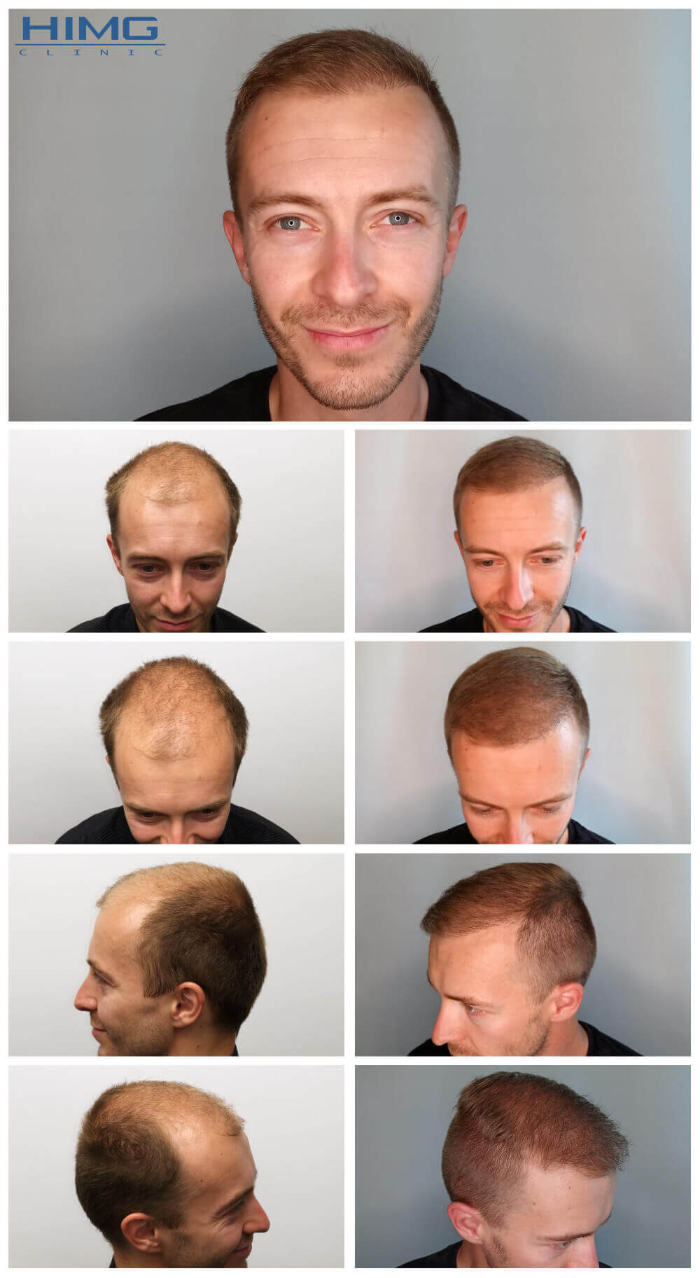 Haartransplantation Vorher - Nachher Bilder - Ergebnisse - Oldřich S. Haartransplantation Vorher - Nachher Bilder - Ergebnisse - Oldřich S.