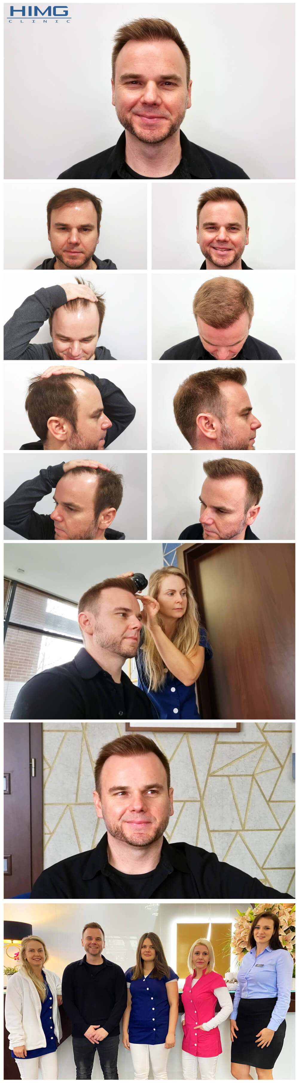 Haartransplantation Vorher - Nachher Bilder - Ergebnisse - Juhász Gergely Haartransplantation Vorher - Nachher Bilder - Ergebnisse - Juhász Gergely