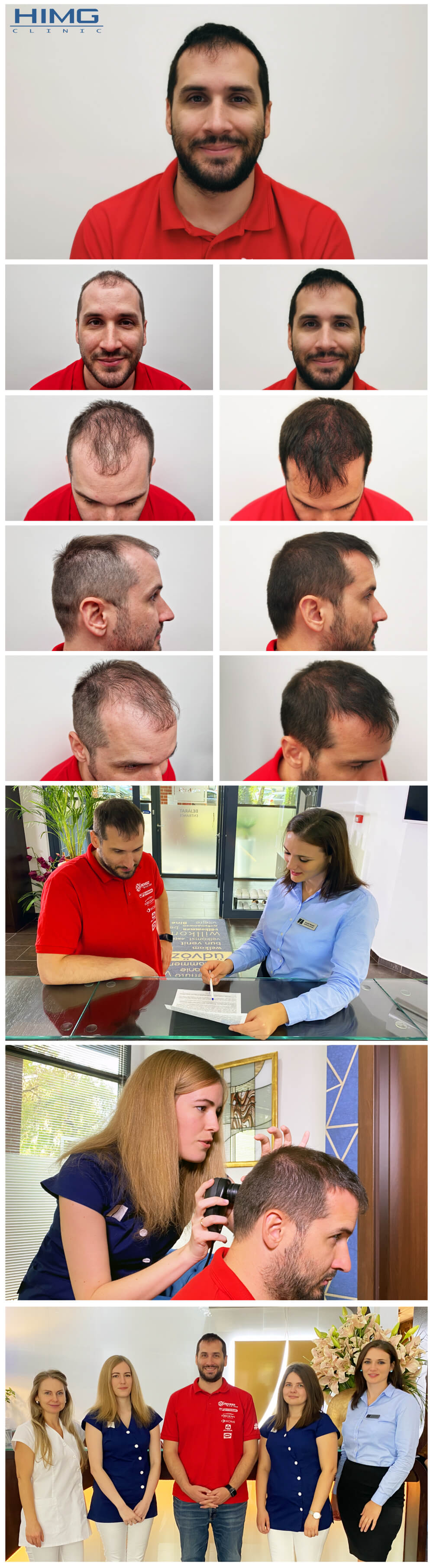 Haartransplantation Vorher - Nachher Bilder - Ergebnisse - Kiss Norbert Haartransplantation Vorher - Nachher Bilder - Ergebnisse - Kiss Norbert