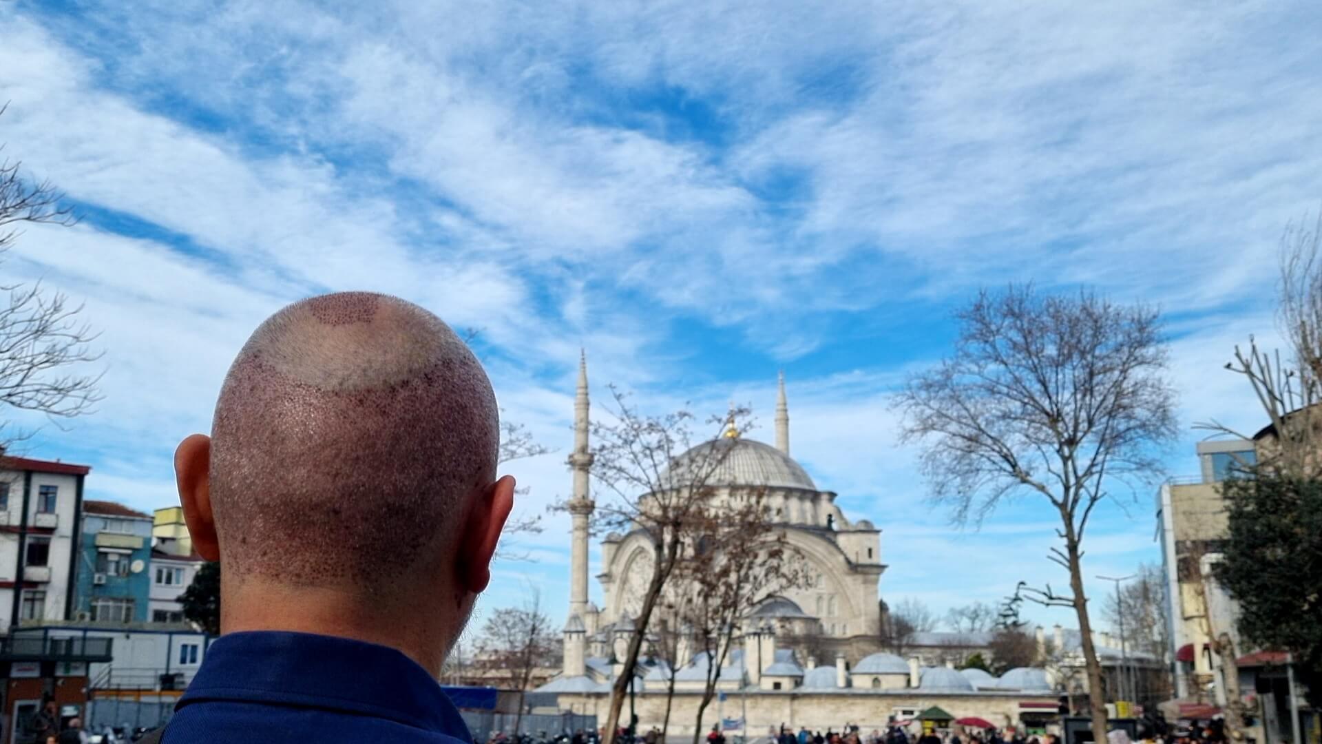 Hajbeültetés Törökországban