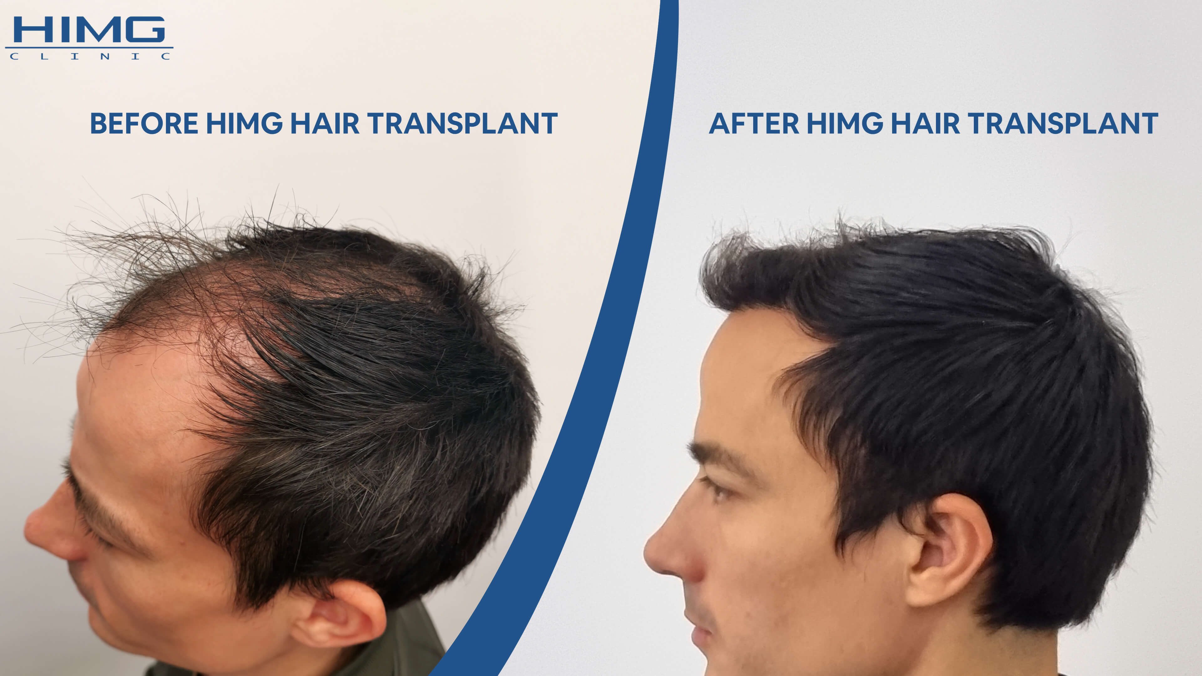 The result of a hair transplant at the HIMG clinic in Budapest