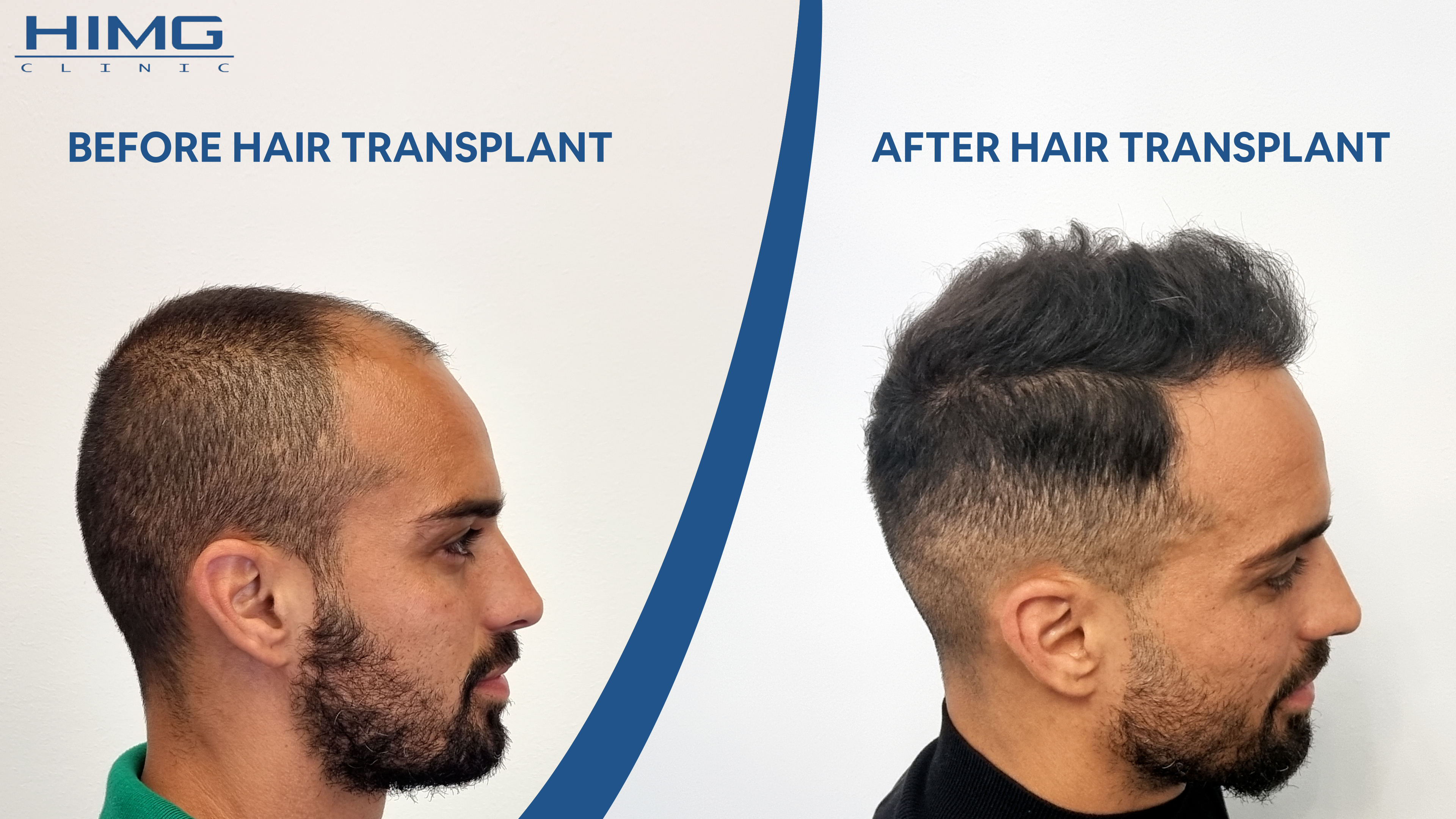 The result of a hair transplant at the HIMG clinic in Budapest