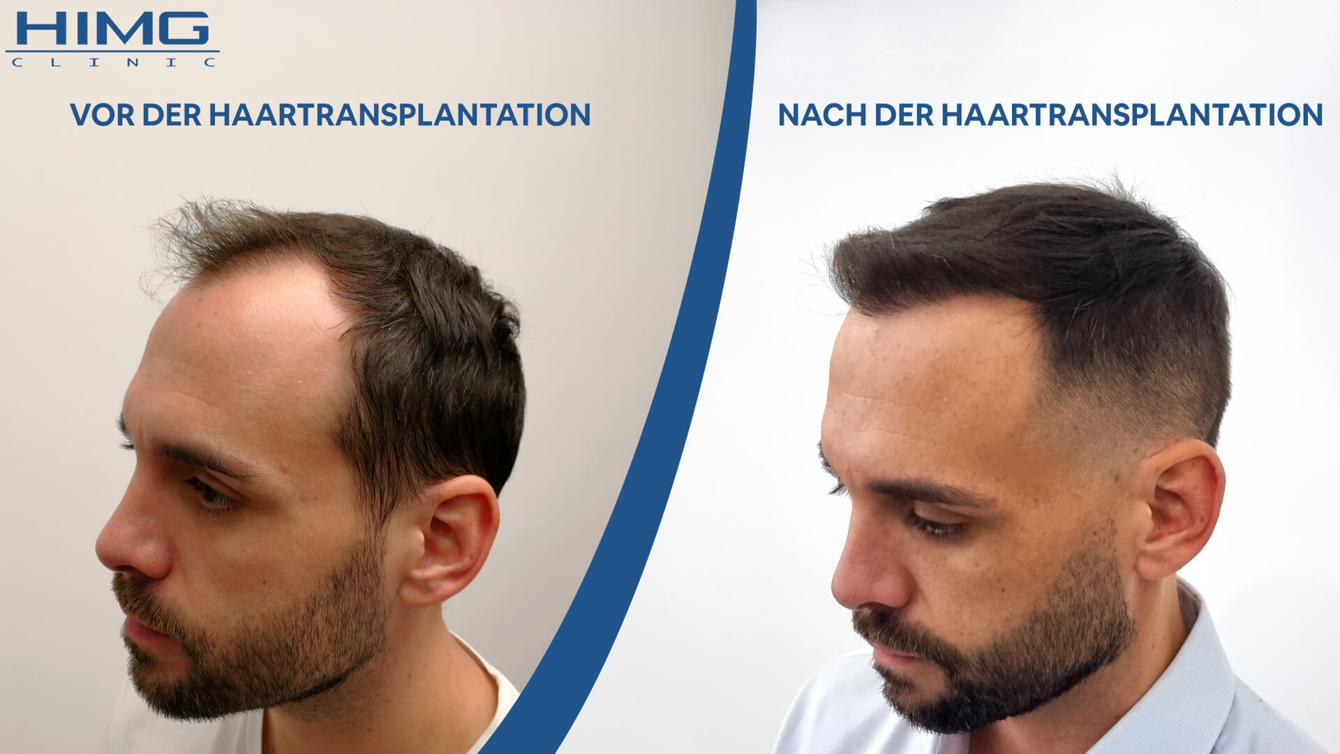 Balázs vor und nach der Haartransplantation