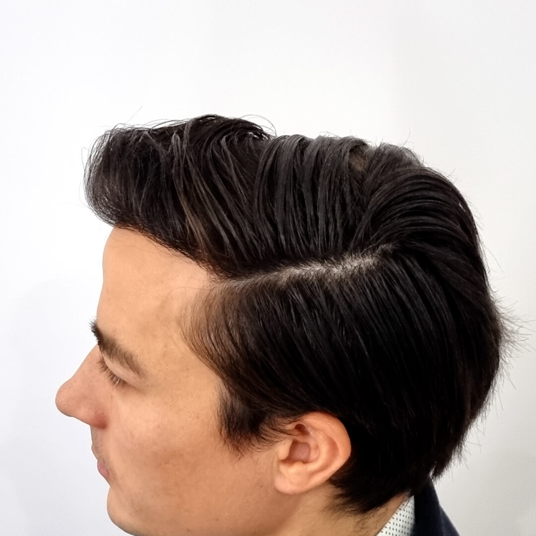 Gregor vor und nach der Haartransplantation mit der preisgekrönten SHE-Methode in der HIMG-Klinik (3900+ transplantierte Grafts)