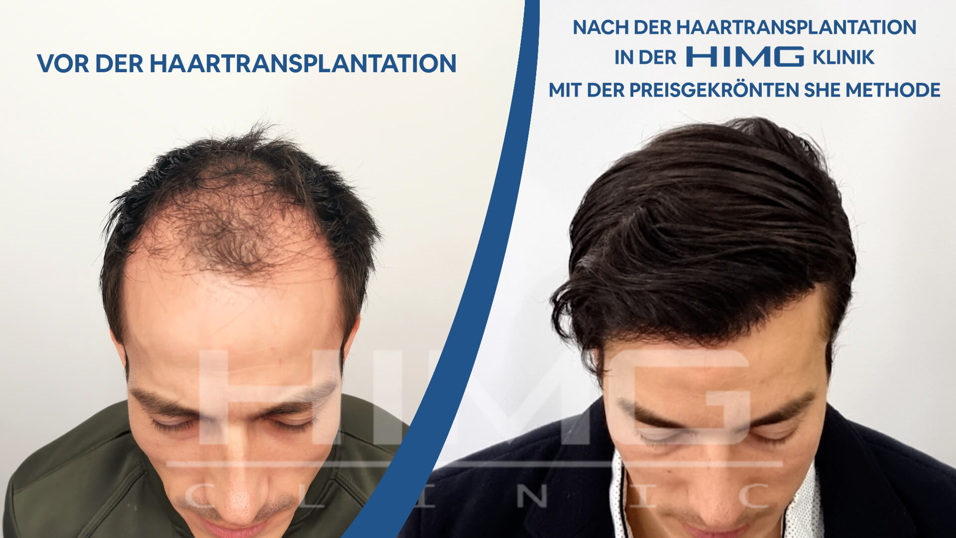 Haartransplantation vorher-nachher: Gergő - HIMG-Klinik title=