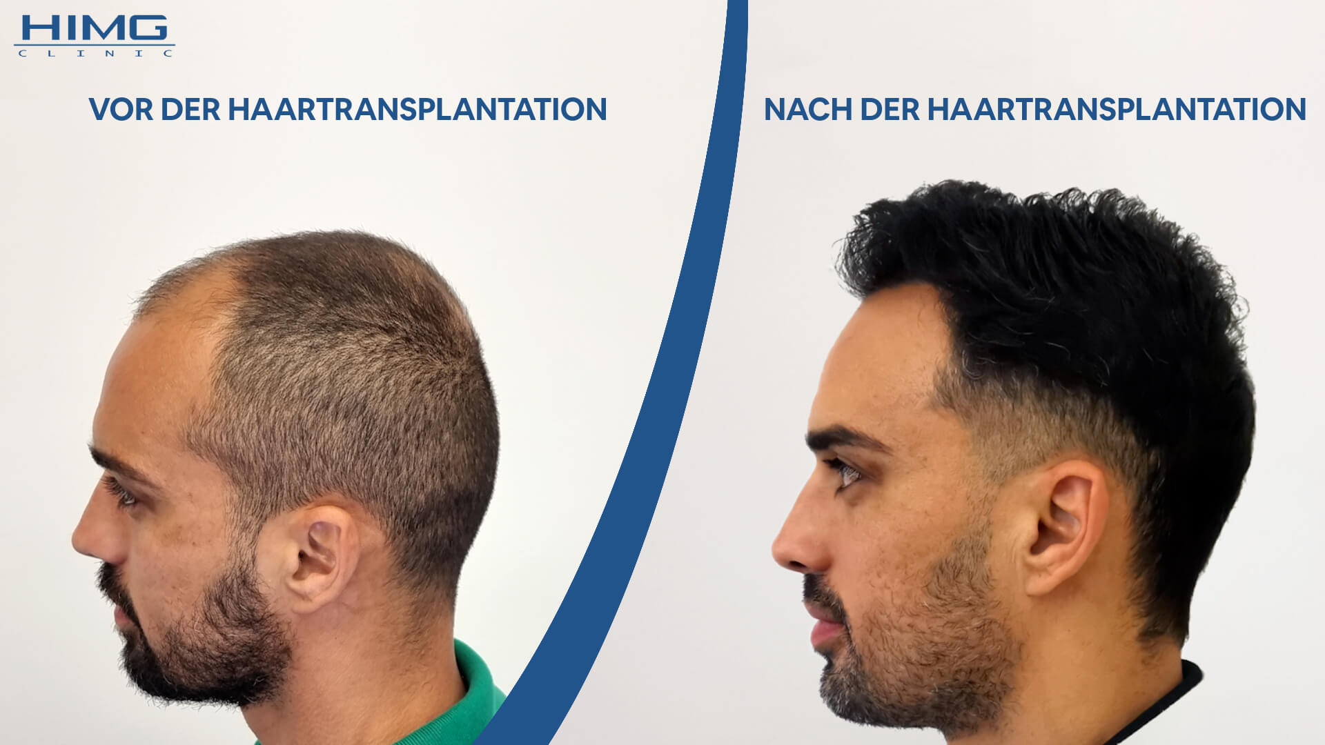 Haartransplantation vorher-nachher: Lucas M.D. Bertucci - HIMG-Klinik