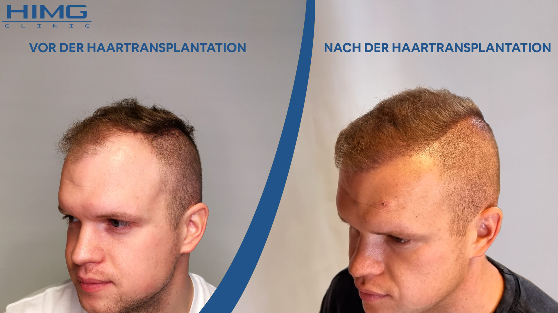 Haartransplantation Vorher - Nachher: Patrik