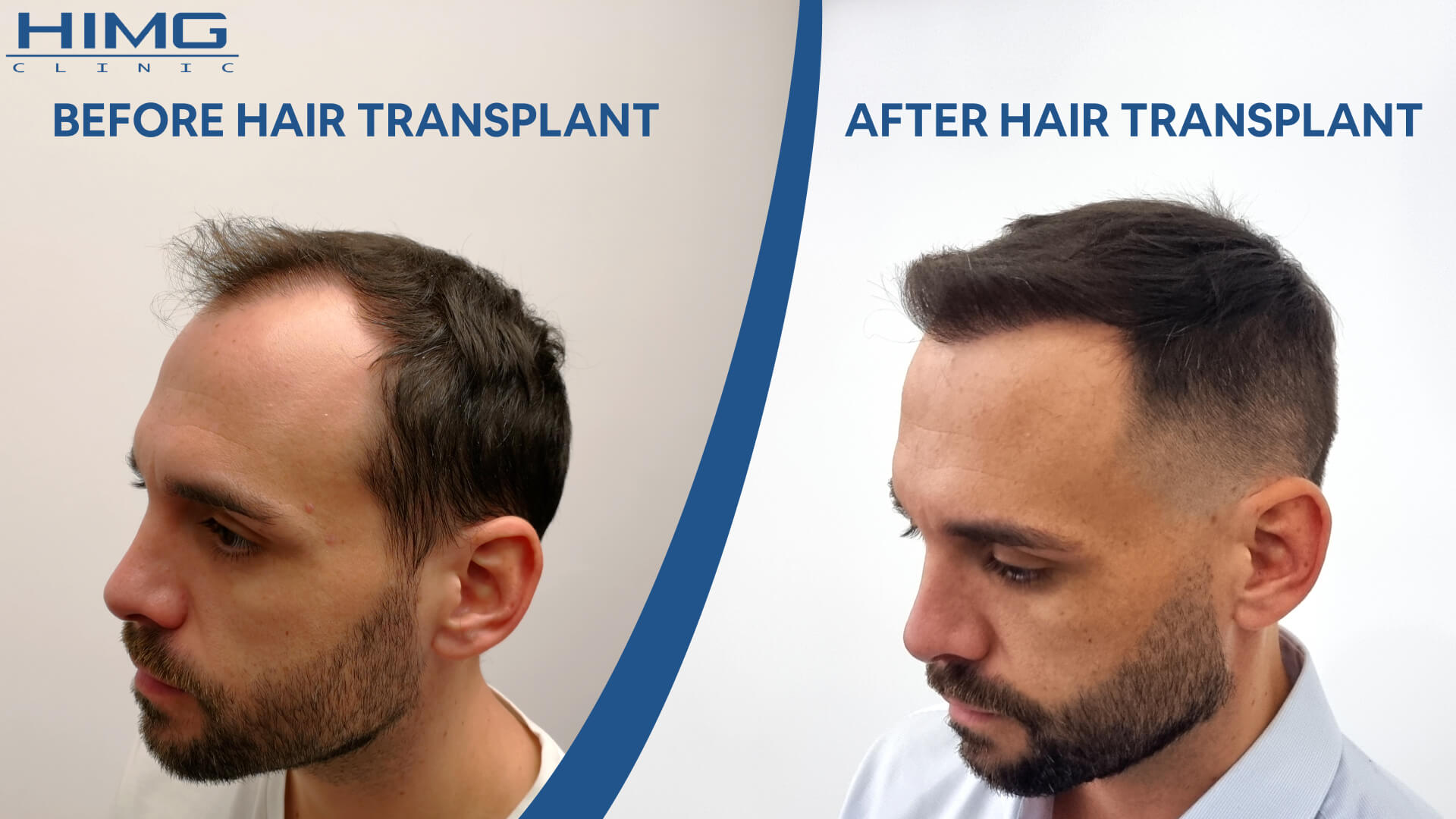 Hair transplant before-after