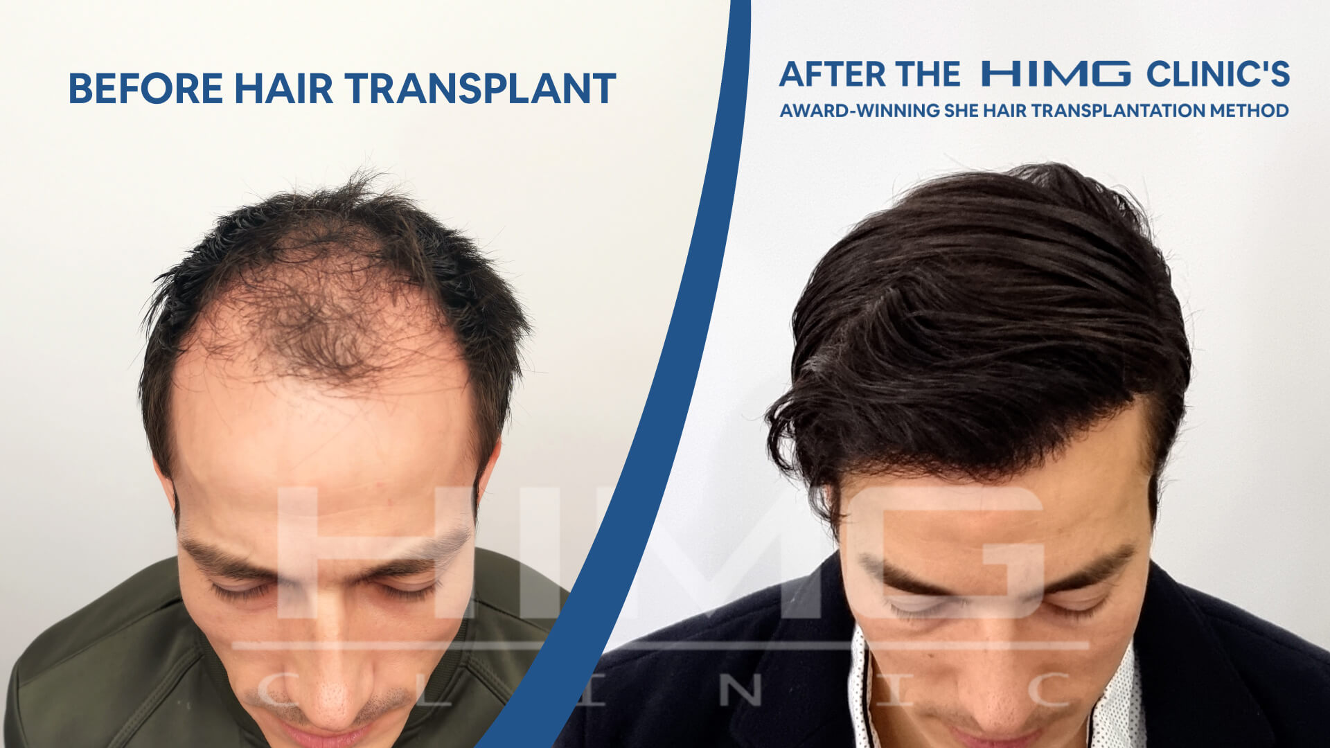 Hair transplant before-after
