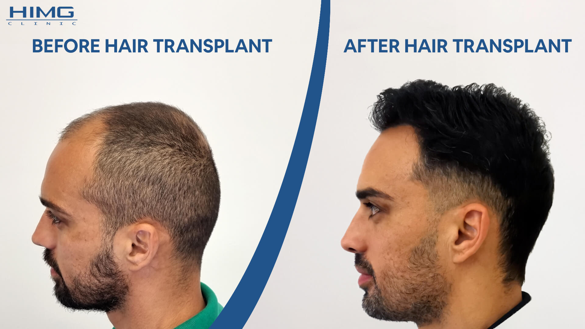 Hair transplant before-after: Lucas - HIMG Clinic